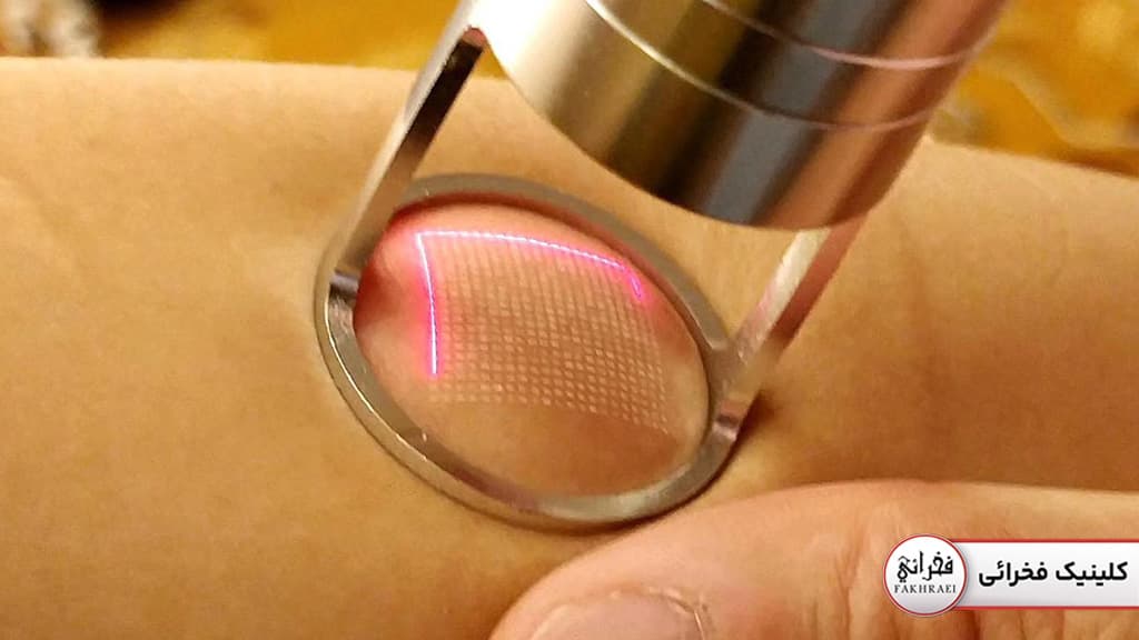 دستگاه لیزر CO2