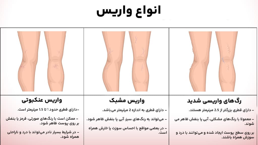 انواع واریس