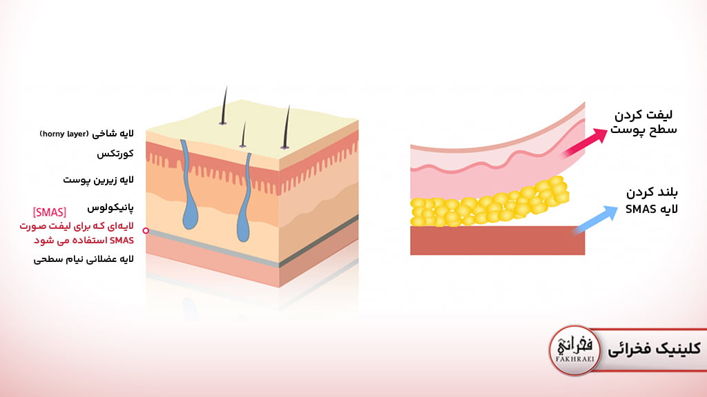 تاثیر هایفوتراپی روی پوست
