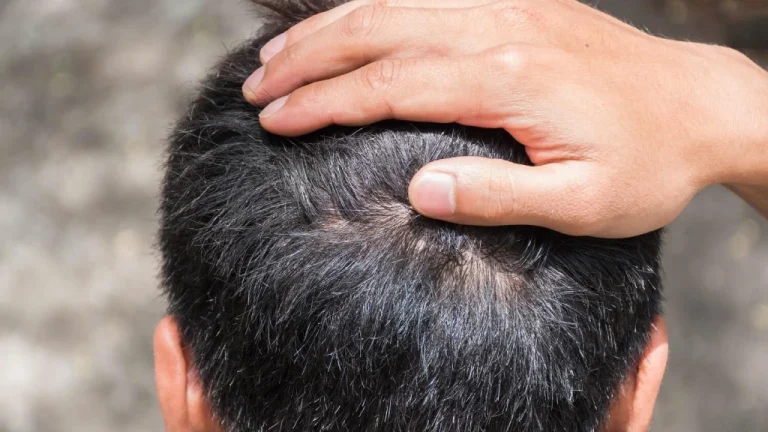 بانک مو بعد از کاشت