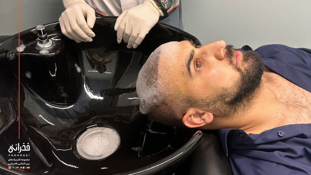 شستشوی سر بعد از کاشت مو