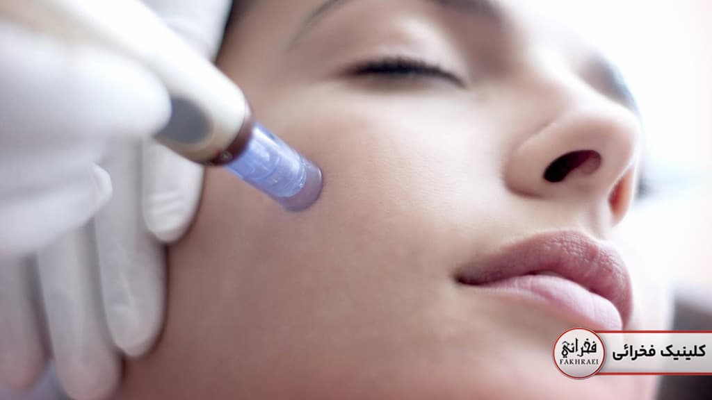 نحوه کار میکرونیدلینگ