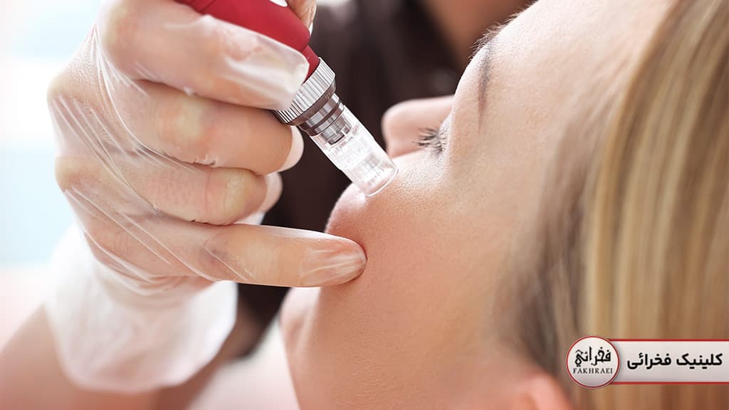 معایب استفاده از میکرونیدلینگ