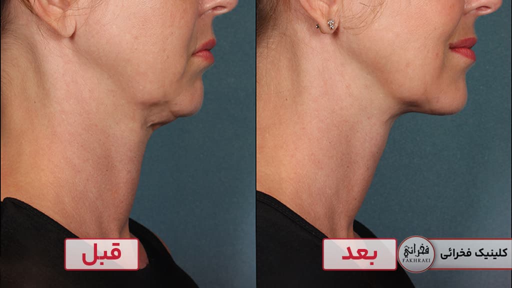 درمان هایفو برای غبغب