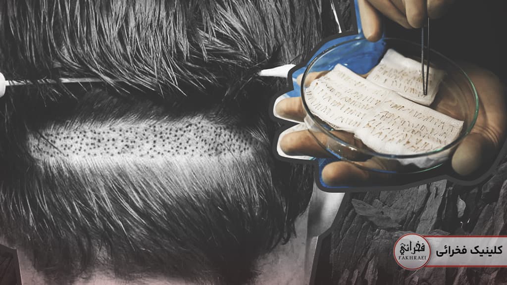 ترمیم بانک م بعد از کاشت