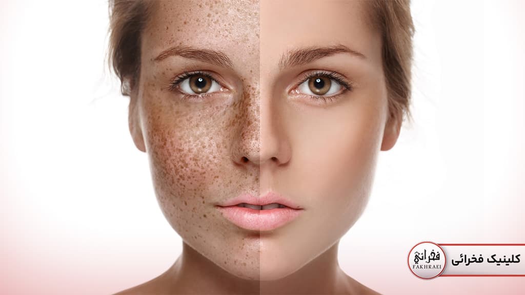 کاربرد لیزر فوتونا و فرکشنال