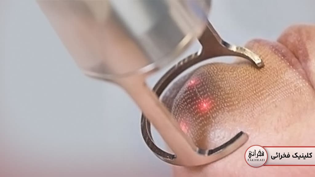 لیزر فرکشنال چیست؟