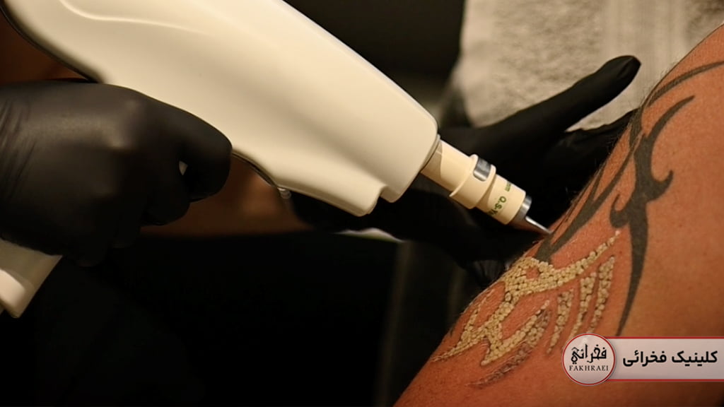 خطرات خالکوبی در طولانی مدت