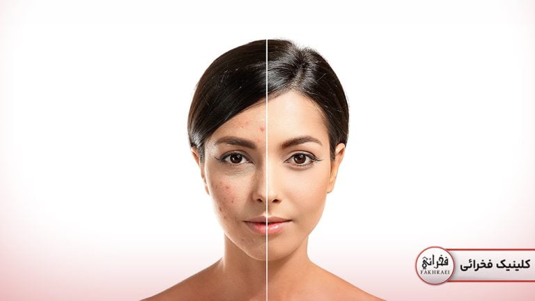 بررسی استفاده از لیزر فوتونا برای جای جوش