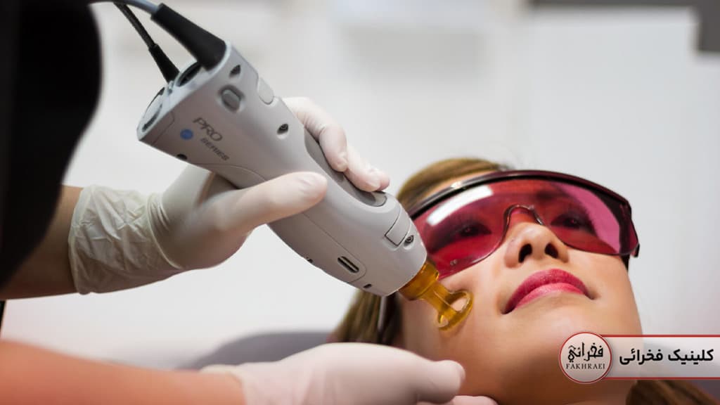 کندلا برای لیزر موهای کرکی صورت