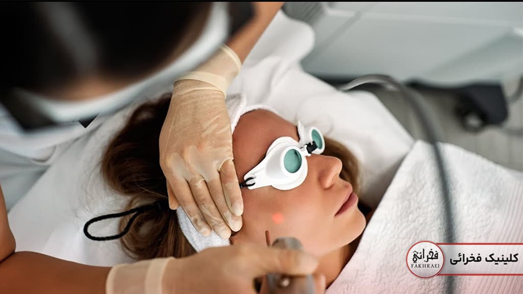 فوتونا برای لیزر مو‌های کرکی صورت