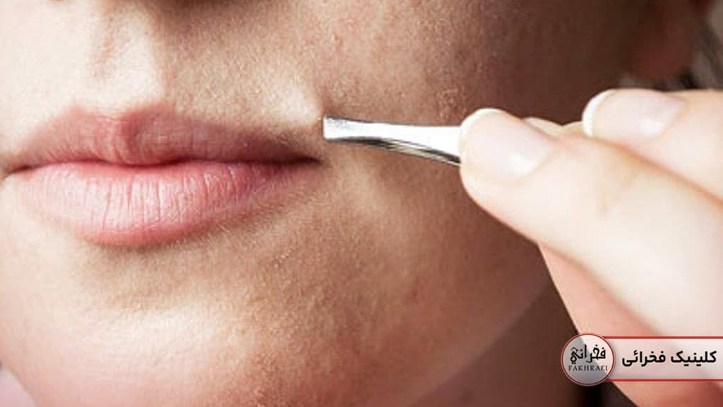 موهای زائد روی صورت زنان