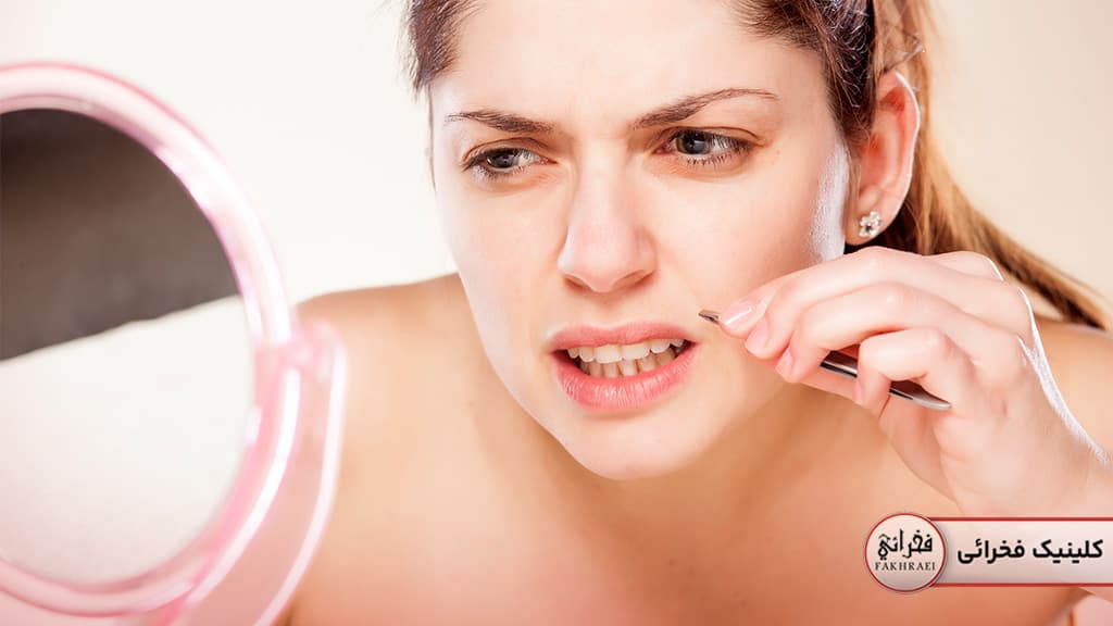 برداشتن موهای کرکی صورت