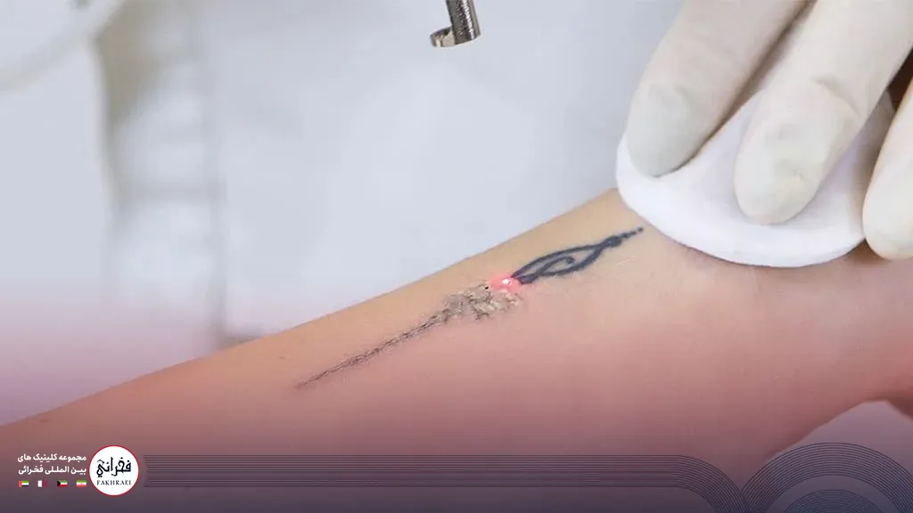 عکس پاک کردن تتو با لیزر کیوسوییچ 