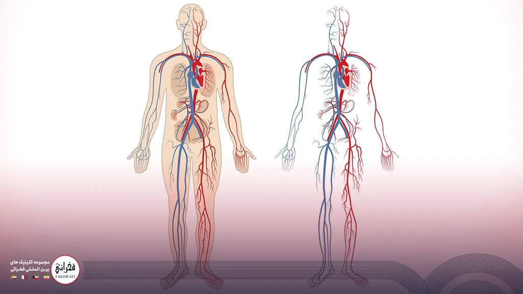 واریس چگونه ایجاد میشود؟
