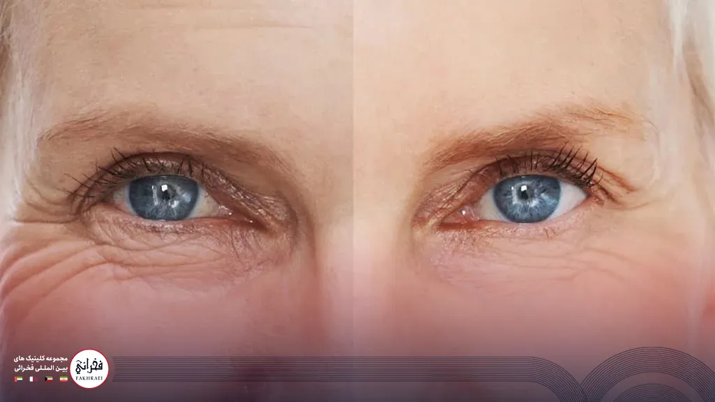 عکس قبل و بعد از انجام لیزر فوتونا برای چروک زیر چشم
