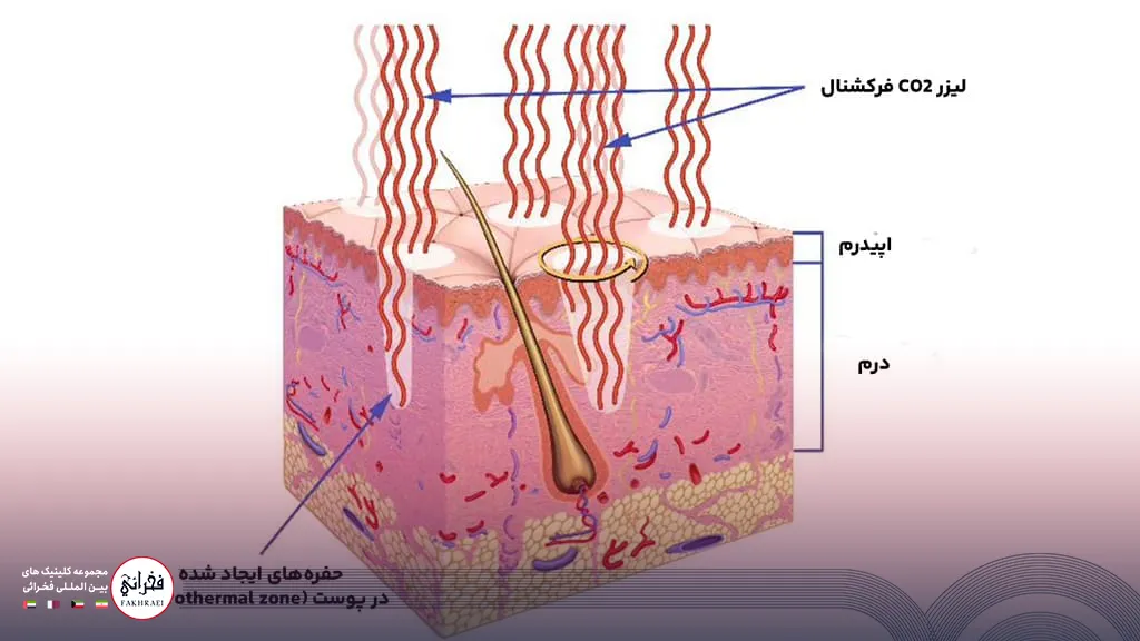 فناوری مورد استفاده در لیزر CO2