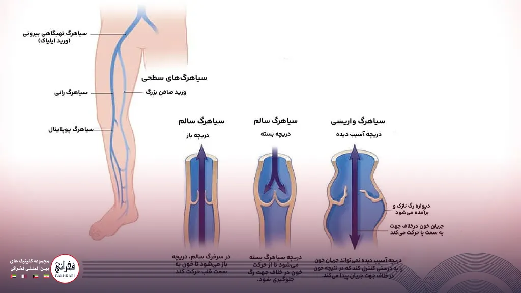درمان واریس