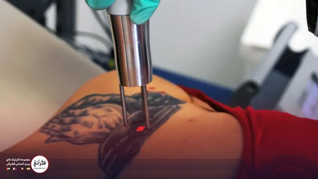 عکس پاک کردن تتو با لیزر کیوسوییچ 