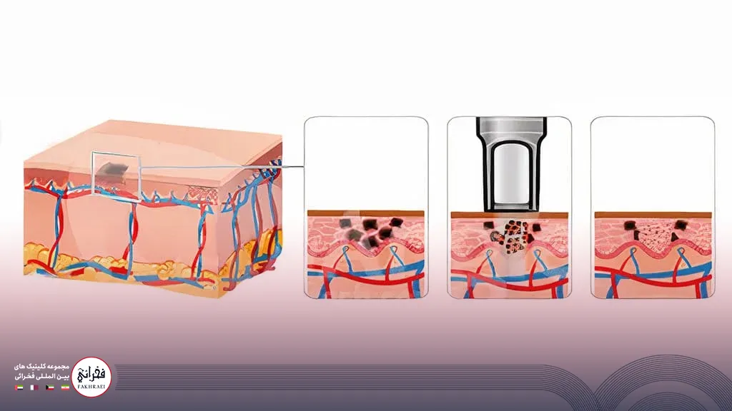 عکس لایه های پوست در حال انجام لیزر کیوسوییچ 
