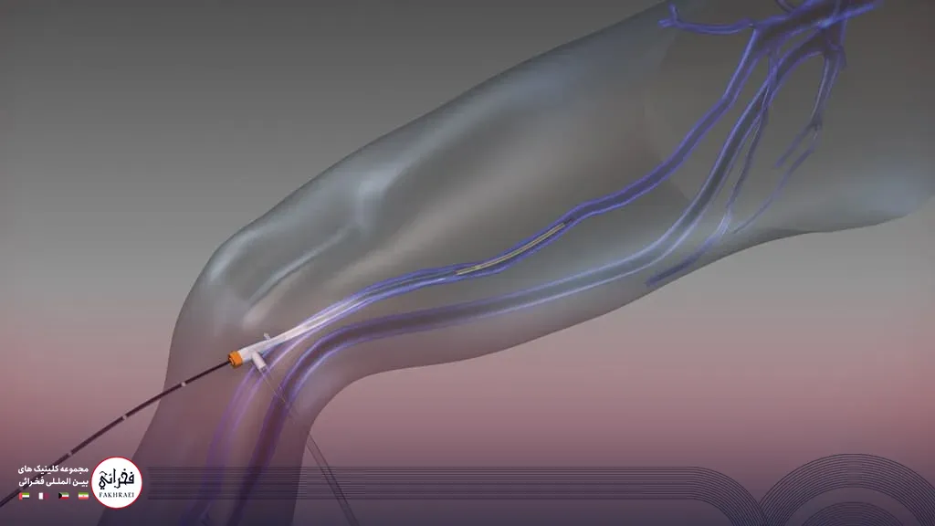 درمان واریس با رادیوفرکوئنسی (RF)