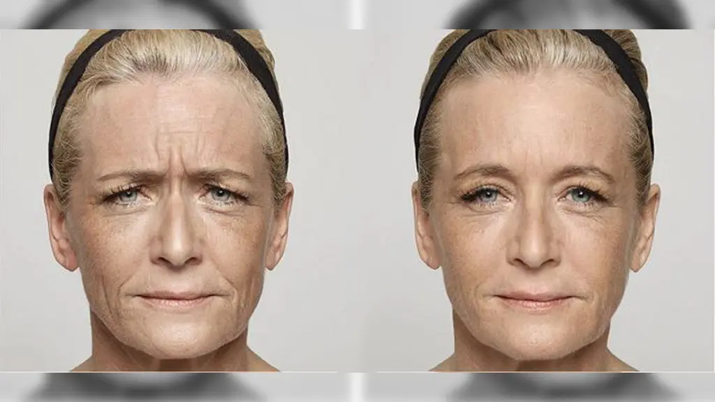 عکس قبل و بعد از تزریق بوتاکس دیسپورت