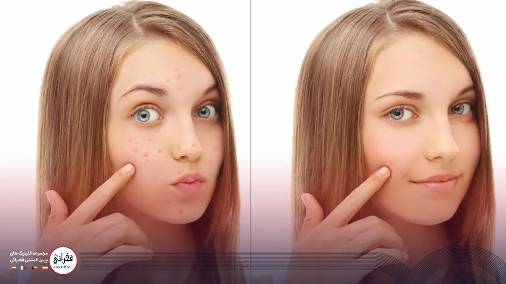 قبل و بعد از انجام لیزر فوتونا