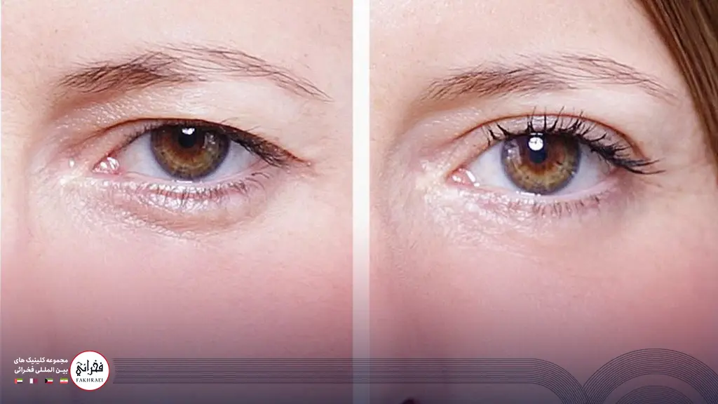 لیزر فوتونا برای افتادگی پلک