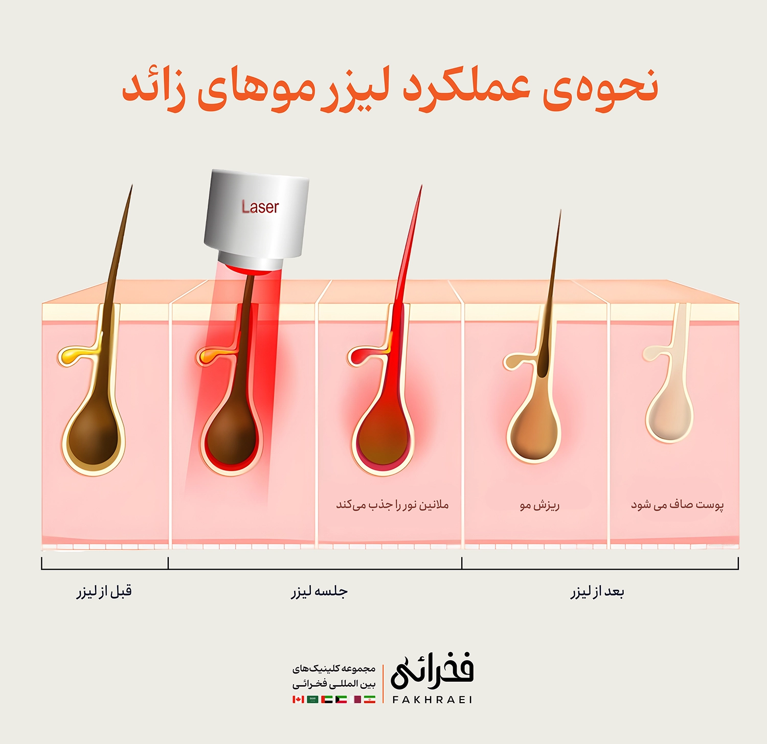 نحوه عملکرد لیزر موهای زائد