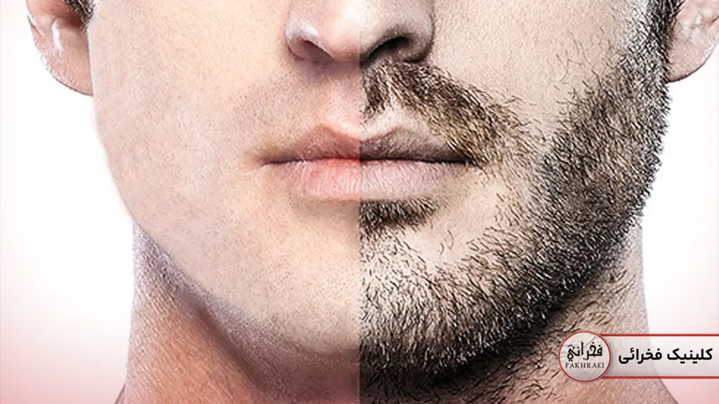 بهترین روش کاشت ریش برای افراد کوسه