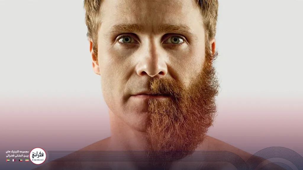 قبل و بعد از کاشت ریش