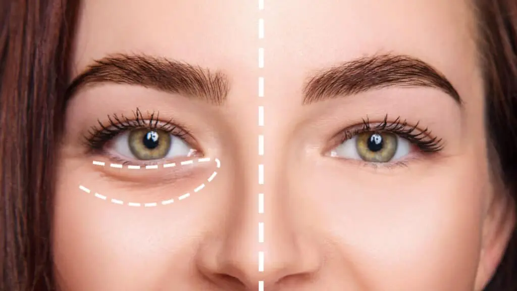 کاندید مناسب برای تزریق فیلر زیر چشم