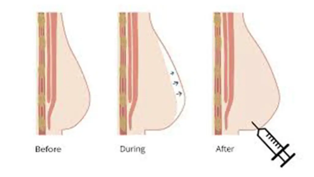 عکس قبل و در حال و بعد از تزریق چربی به سینه