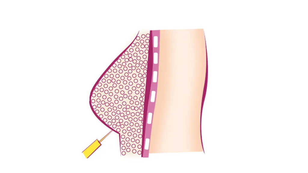 عکس کارتونی تزریق چربی به سینه