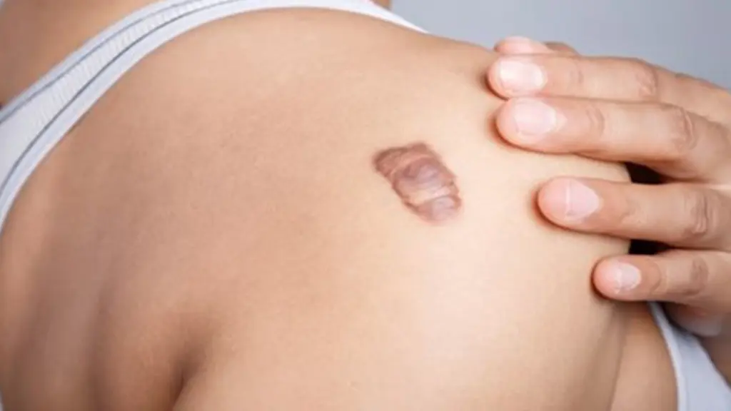 برداشتن گوشت اضافه