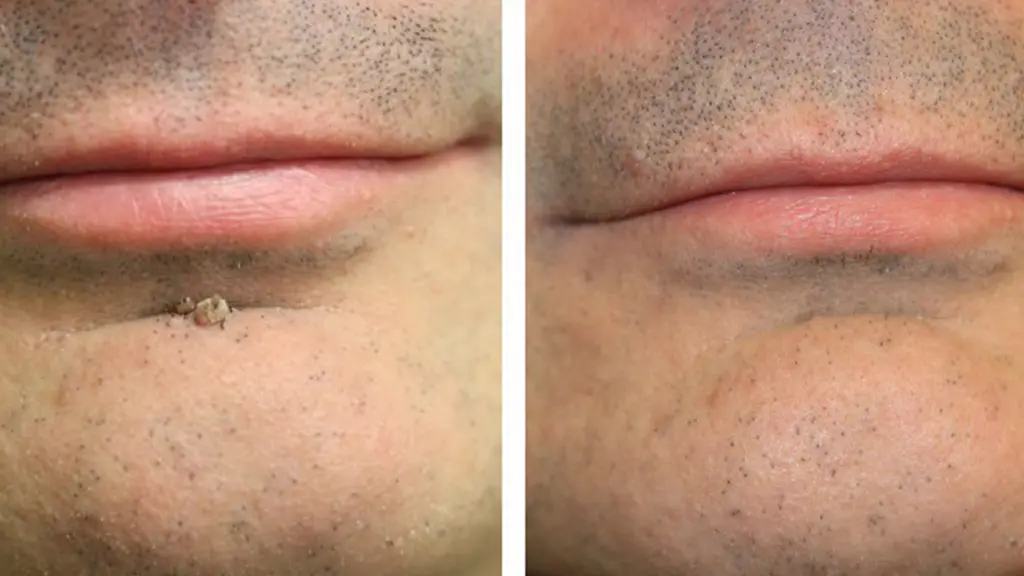 عوارض لیزر co2 برای حذف گوشت اضافه