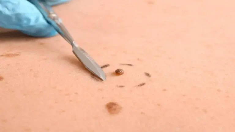 حذف گوشت اضافه با لیزر CO2 | درمان مؤثر کلوئید بدون جراحی