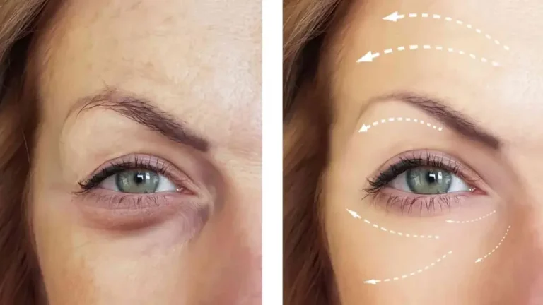 تزریق مزوژل زیر چشم | رفع تیرگی، گودی و چینوچروک با ماندگاری بالا