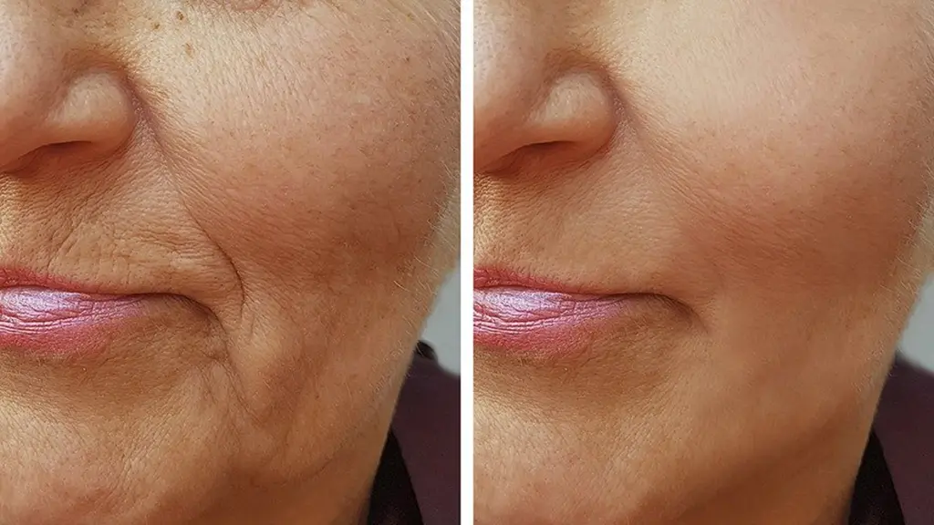 قبل و بعد از خط خنده