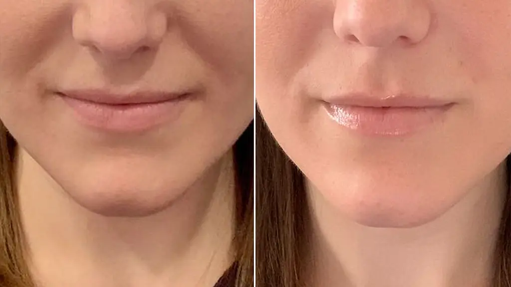 قبل و بعد از فیلر خط خنده