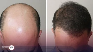 کاشت مو در ناحیه ورتکس