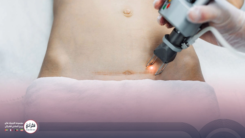 لیزر فوتونا برای جای بخیه-درحال لیزر جای بخیه شکم