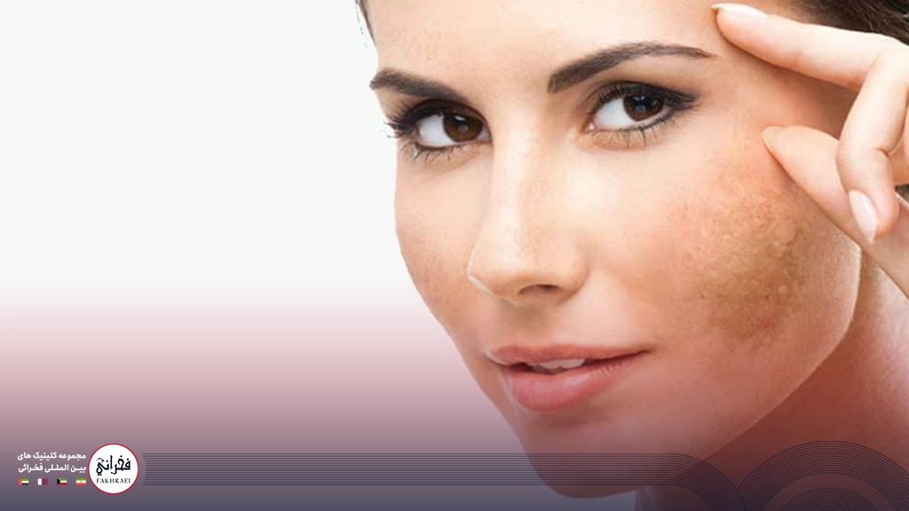 لیزر فوتونا برای جای بخیه-زنی با پوست لک دار