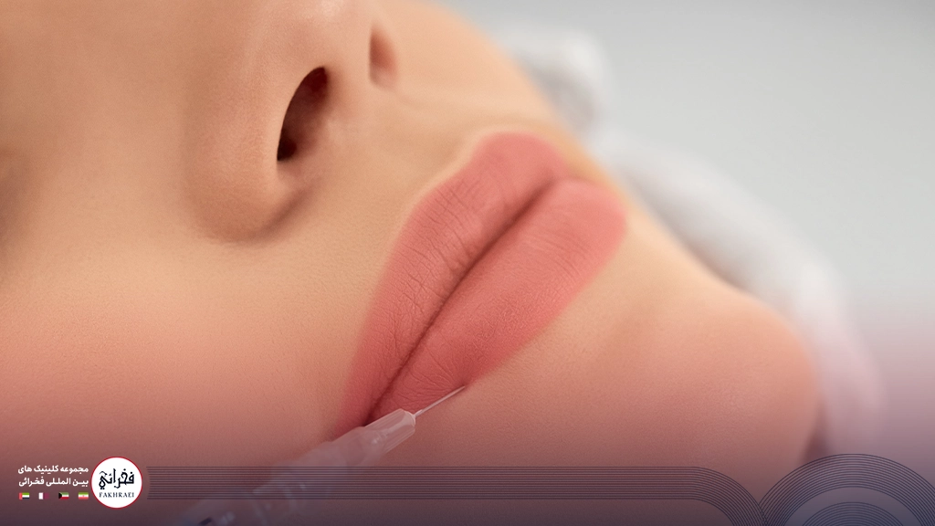 تزریق ژل لب مدل صدفی-در حال تزریق ژل لب