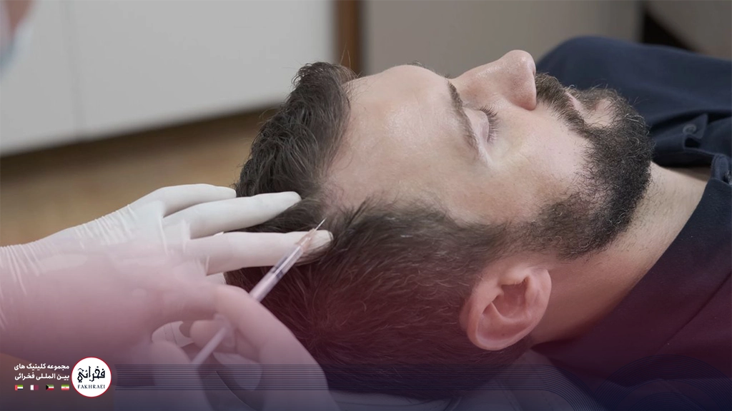 درمان ریزش مو با مزوتراپی