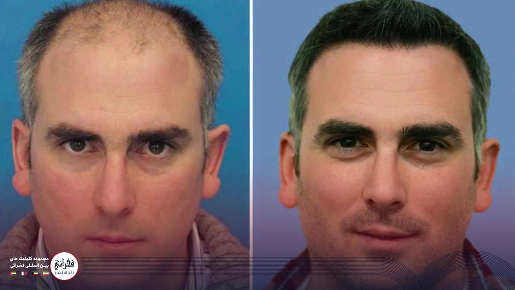 کاشت مو در ناحیه ورتکس-قبل و بعد مردی بعد از کاشت