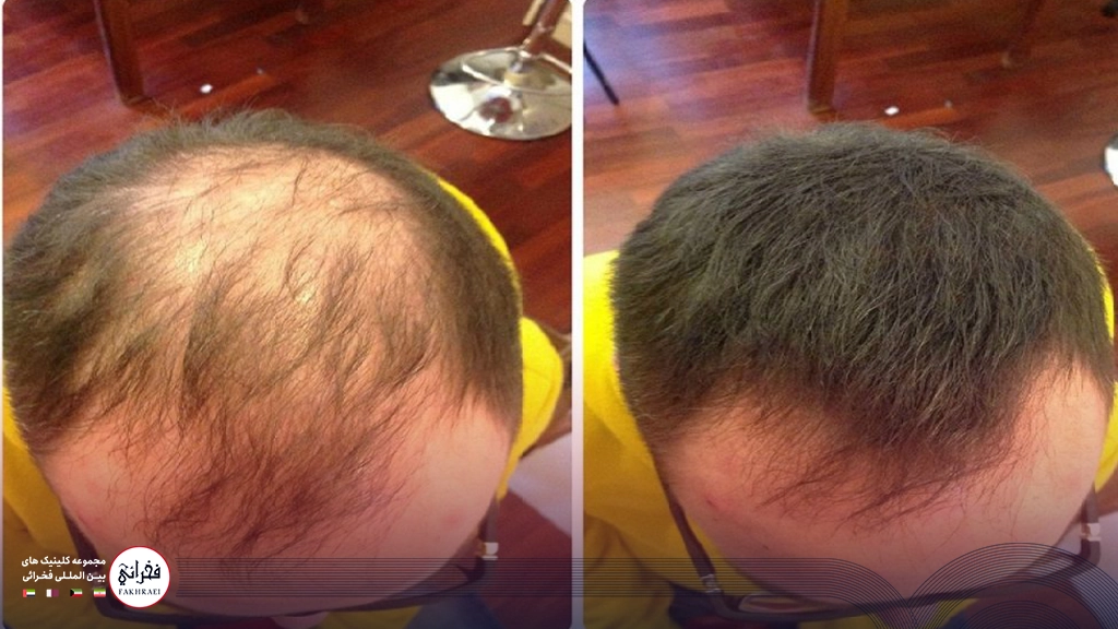 کاشت مو در ناحیه ورتکس-قبل و بعد مردی بعد از کاشت