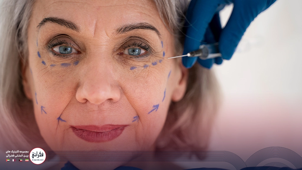 لیفت شقیقه با نخ-خانومی مسن با چشمان آبی و پوست افتاده