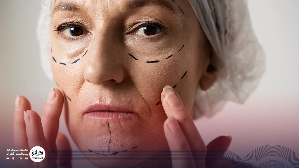 لیفت شقیقه با نخ-خانومی مسن باپوست افتاده