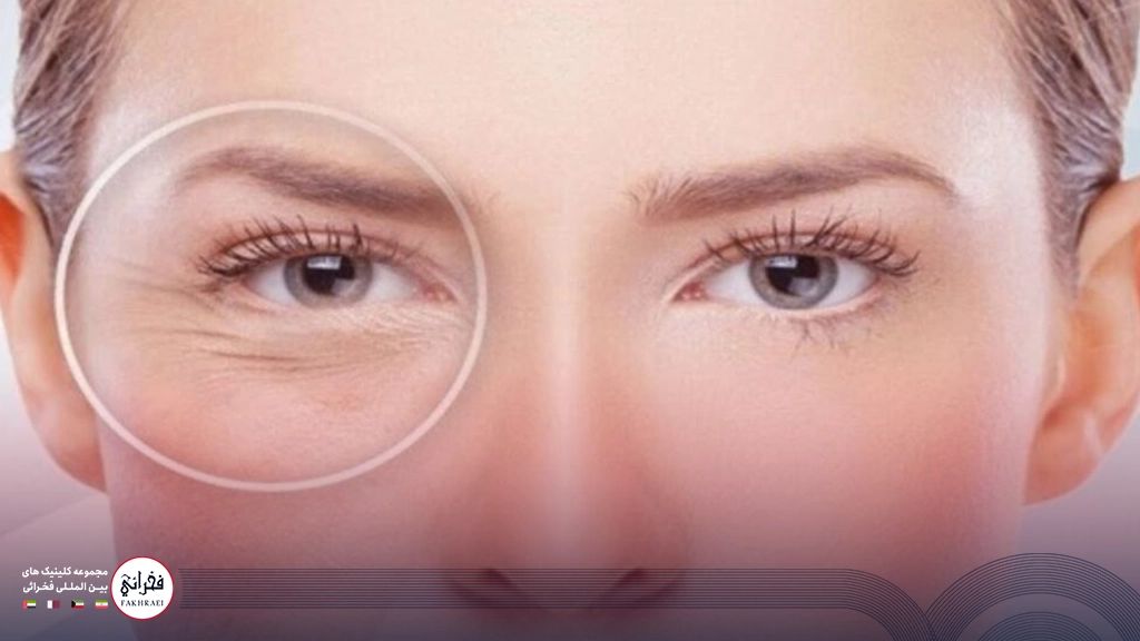 مزوتراپی زیر چشم-زیر چشم چرو کخانومی 